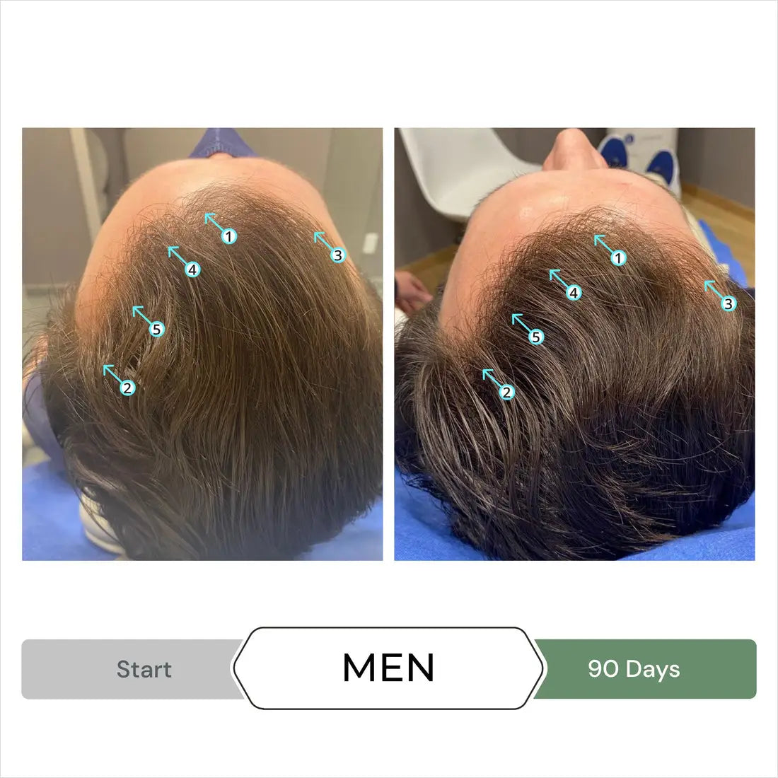 Men's Hair Loss Treatment Before & After: See Hair Growth Results