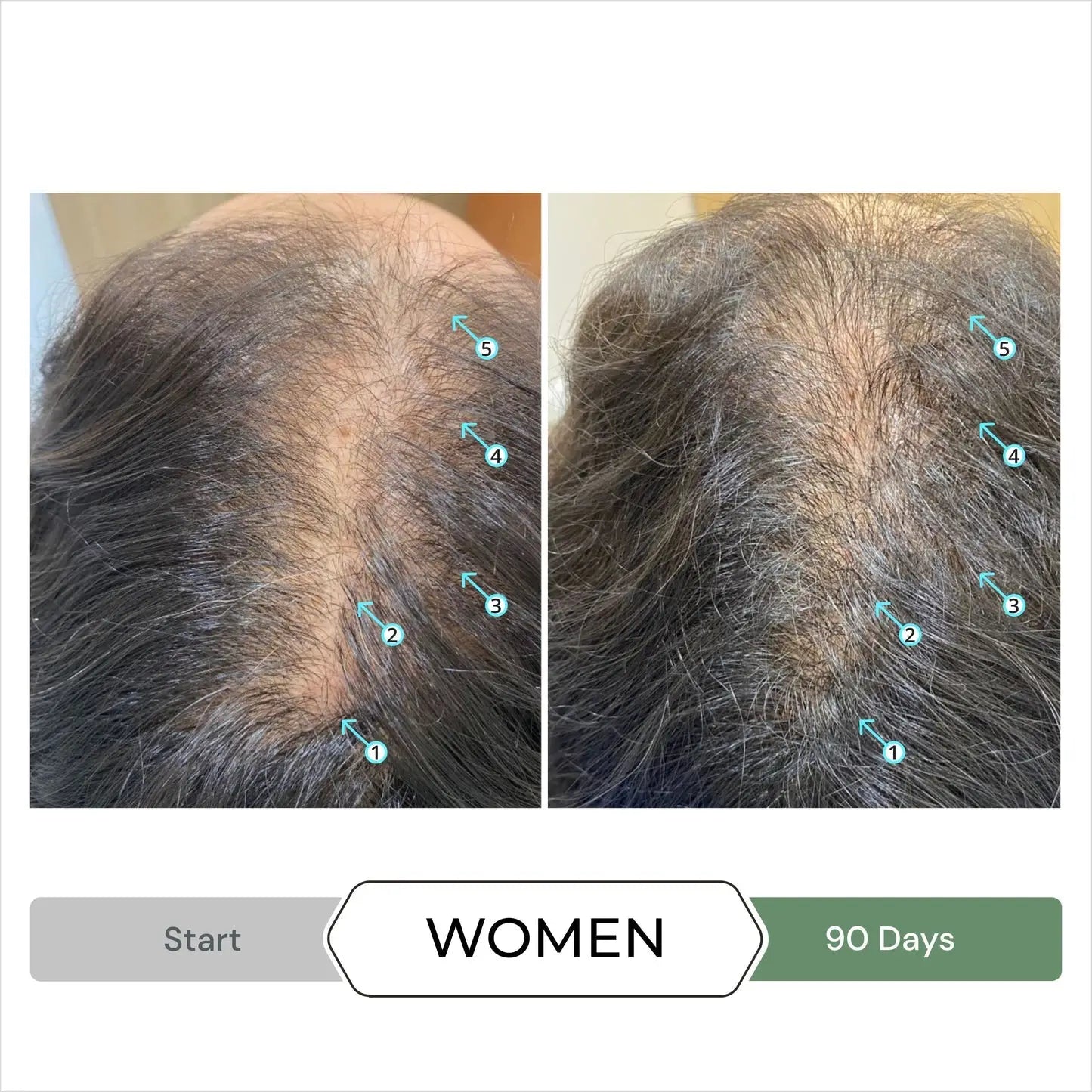 Before and after hair growth comparison using DS Laboratories CBD Hair Stimulating Conditioner