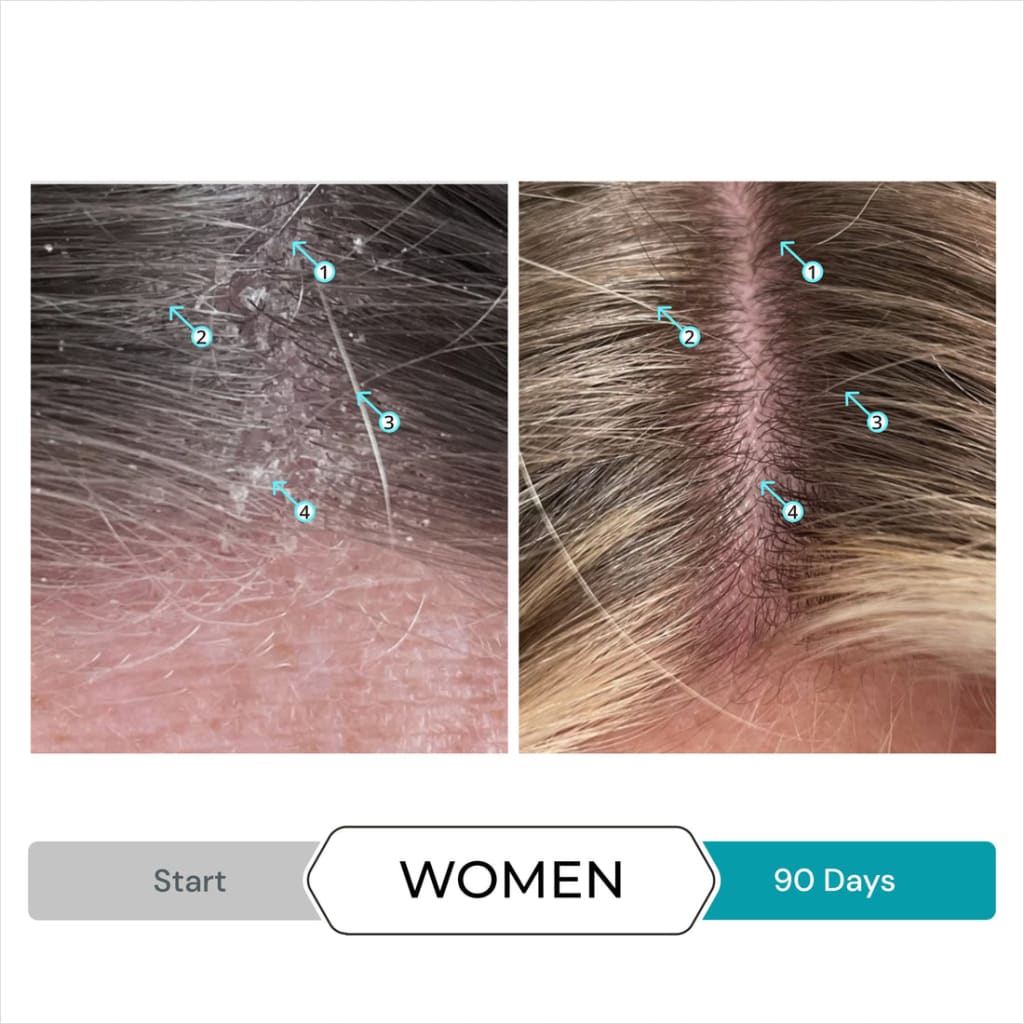 Before-and-after of a woman’s scalp 90 days using DS Laboratories Dandrene Anti Dandruff Shampoo