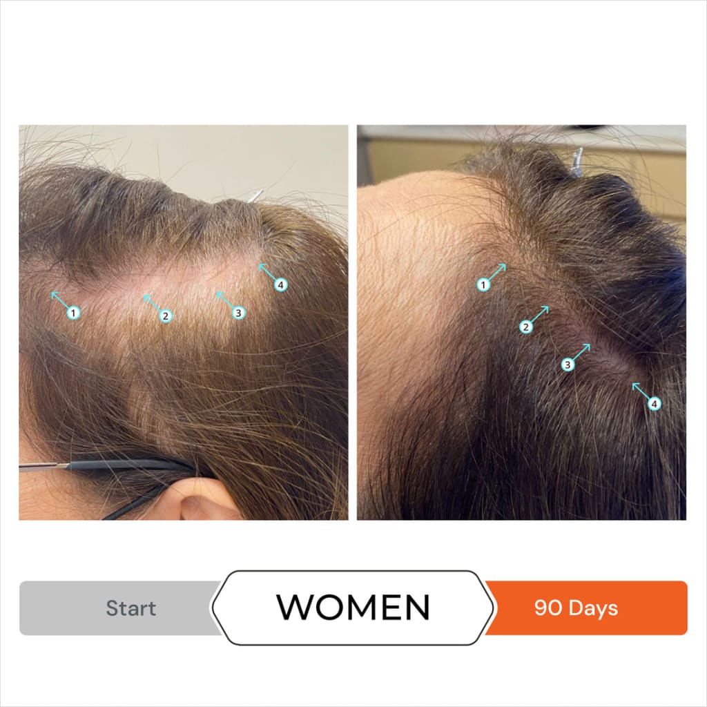 Before and after hair growth photos using Revita Anti Hair-Loss Shampoo over 90 days