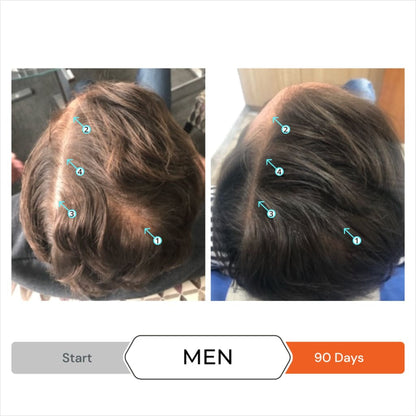 Before-and-after man hair thickness using DS Laboratories Revita Anti Hair-Loss Shampoo