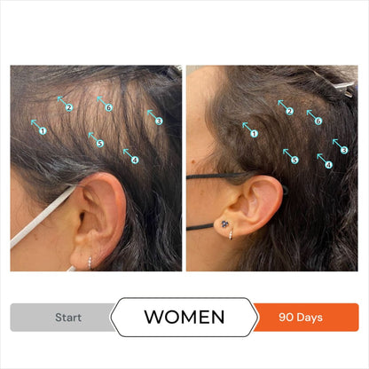 Before and after of woman’s hair growth using DS Laboratories Revita Anti Hair-Loss Shampoo