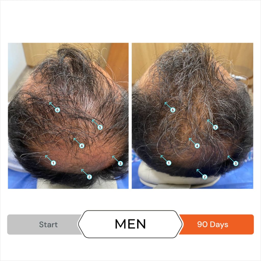 Before and after results using DS Laboratories Revita Anti Hair-Loss Shampoo - 205ml