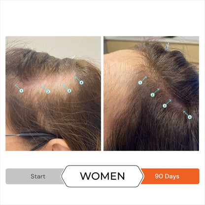 Before-and-after comparison of hair growth in women over 90 days.