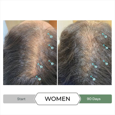 Women's Hair Growth Results: CBD Shampoo Before & After. DS Laboratories Revita CBD Shampoo.