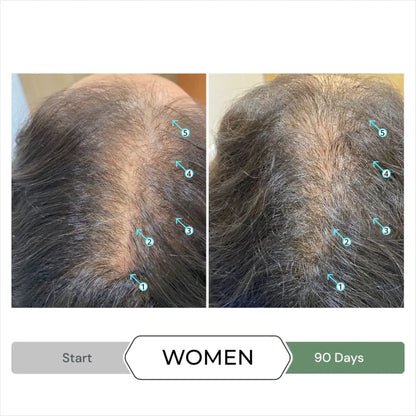 Before-and-after comparison of hair growth on a scalp over 90 days.