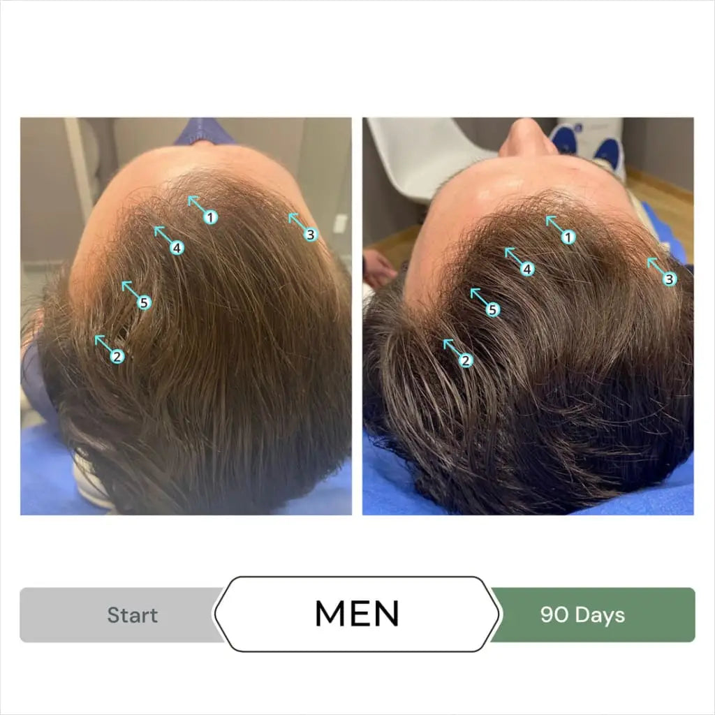 Before-and-after comparison of a man’s hair growth over 90 days.