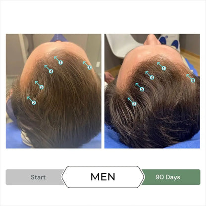 Before-and-after comparison of a man’s hair growth over 90 days.