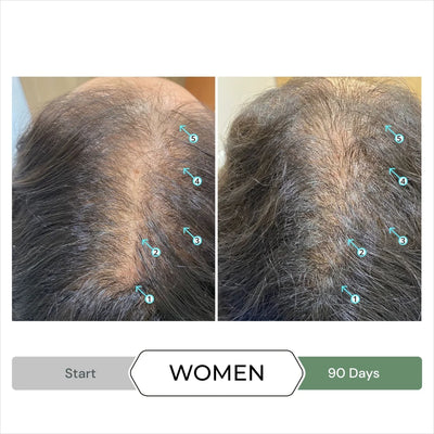 Women's Hair Loss Before & After: Hair Density Improved with Treatment. See Hair Growth Results! 
