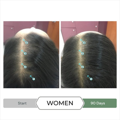 Hair thinning treatment for women: Before & After. DS Laboratories Revita.CBD for hair density. See results!
