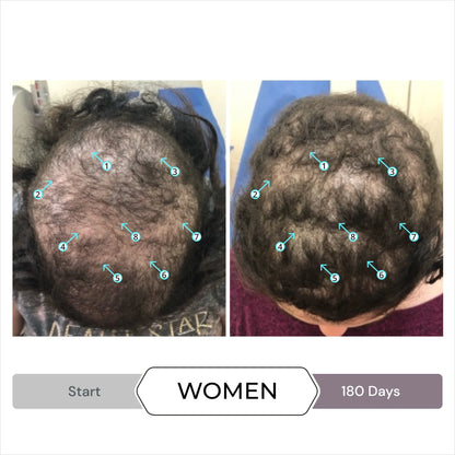 Before and after results showcasing DS Laboratories Spectral Csf 60ml - Hair Loss Solution for women's hair revitalization.