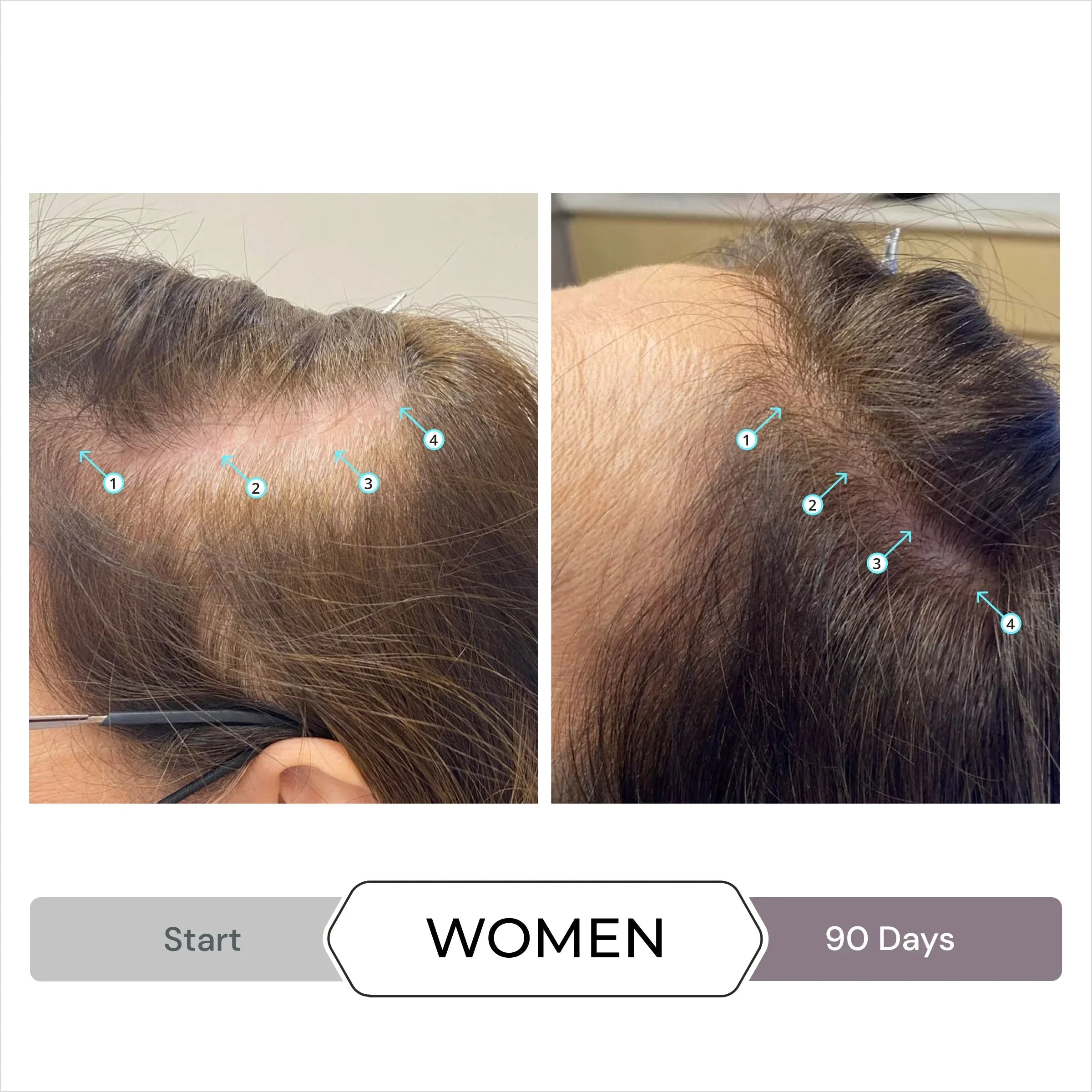 Before and after results showcasing the effectiveness of DS Laboratories Spectral Csf 60ml - Hair Loss Solution for women.