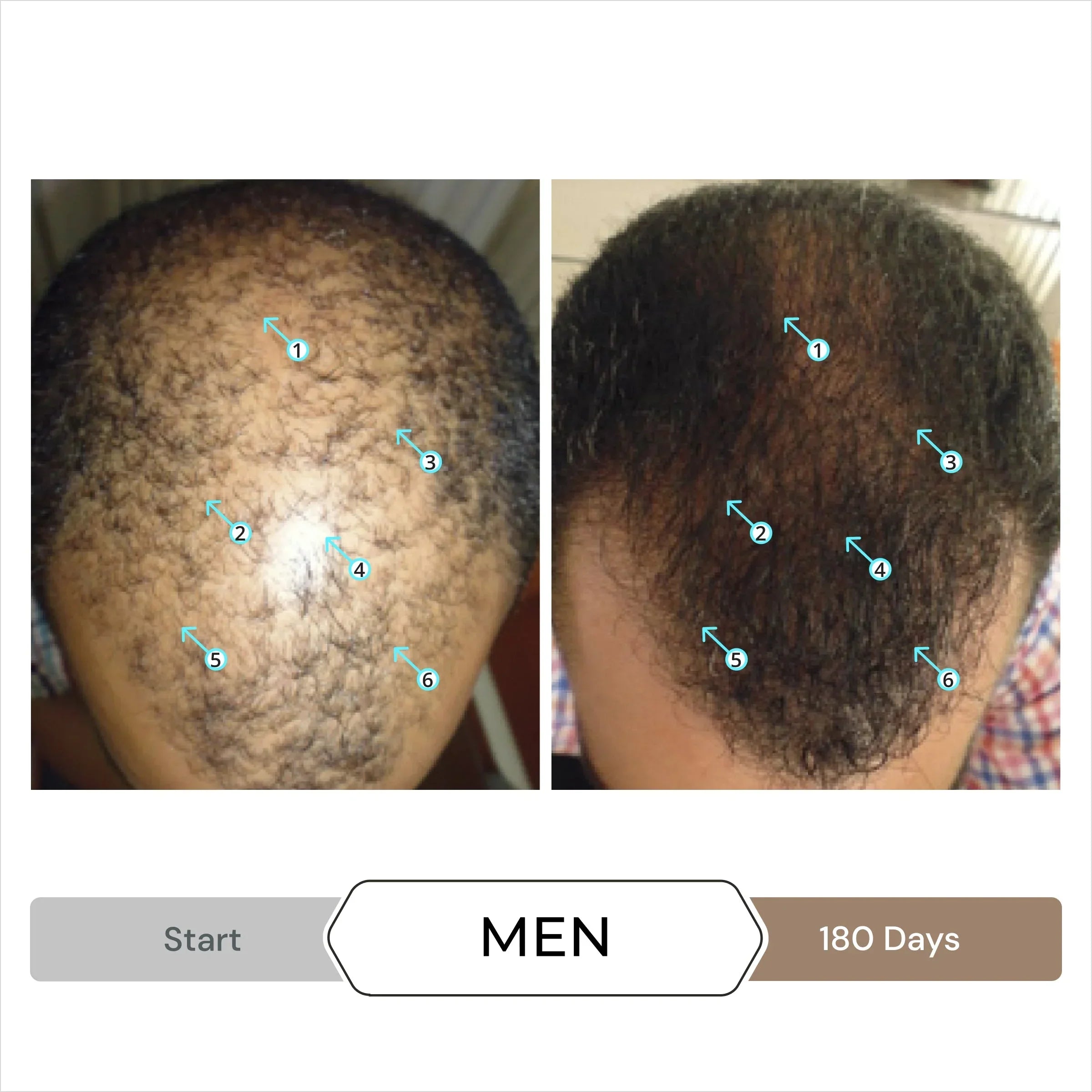 Before and after results showcasing hair growth from DS Laboratories Spectral.DNC-N Topical Serum - N 5% - 60ml.