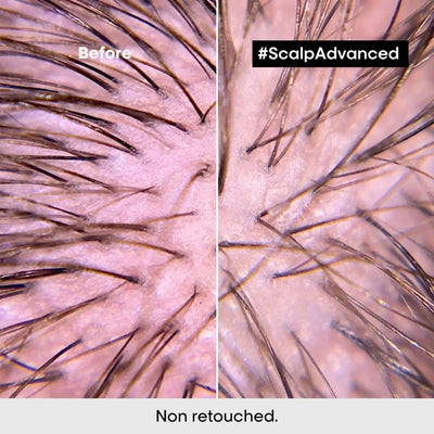 Scalp Health Before & After: L'Oreal Scalp Advanced. See the difference with our hair treatment for sensitive scalps.