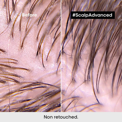 L'Oreal Scalp Advanced: Before & After Oily Scalp Treatment. See Reduced Sebum & Healthier Hair Growth with our deep purifier clay shampoo.