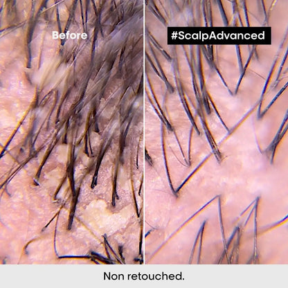 Close-up of scalp and hair follicles before and after L’Oréal Professionnel Scalp Advanced treatment