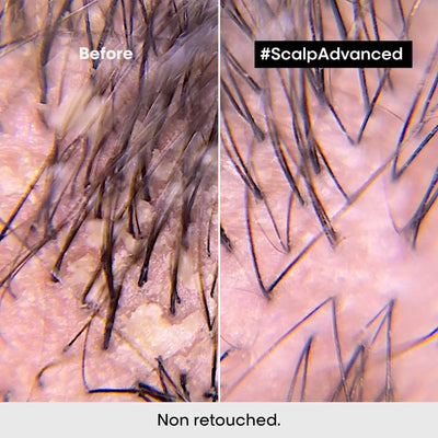 L'Oréal Scalp Advanced: Before & After Dandruff Treatment. Healthy Scalp Results.