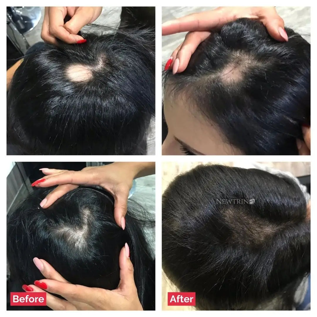 Before and after hair density improvement with Newtrino 100ml Scalp Serum for hair loss