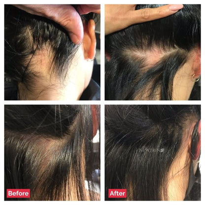 Newtrino 100ml Scalp Serum boosts hair density: Before and after results on a person’s scalp