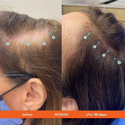 Hair Growth Transformation: Before & After 90 Days with Revita - Hair Loss Treatment for Women