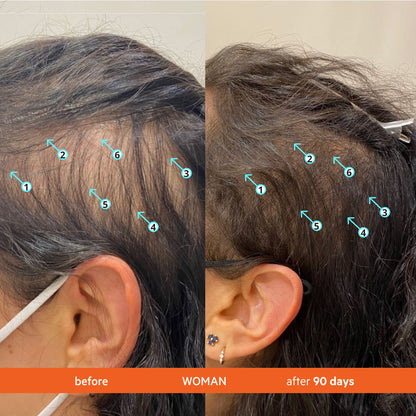 Hair Growth Transformation: Before & After 90 Days. Visible increase in hair density using [Product Name].