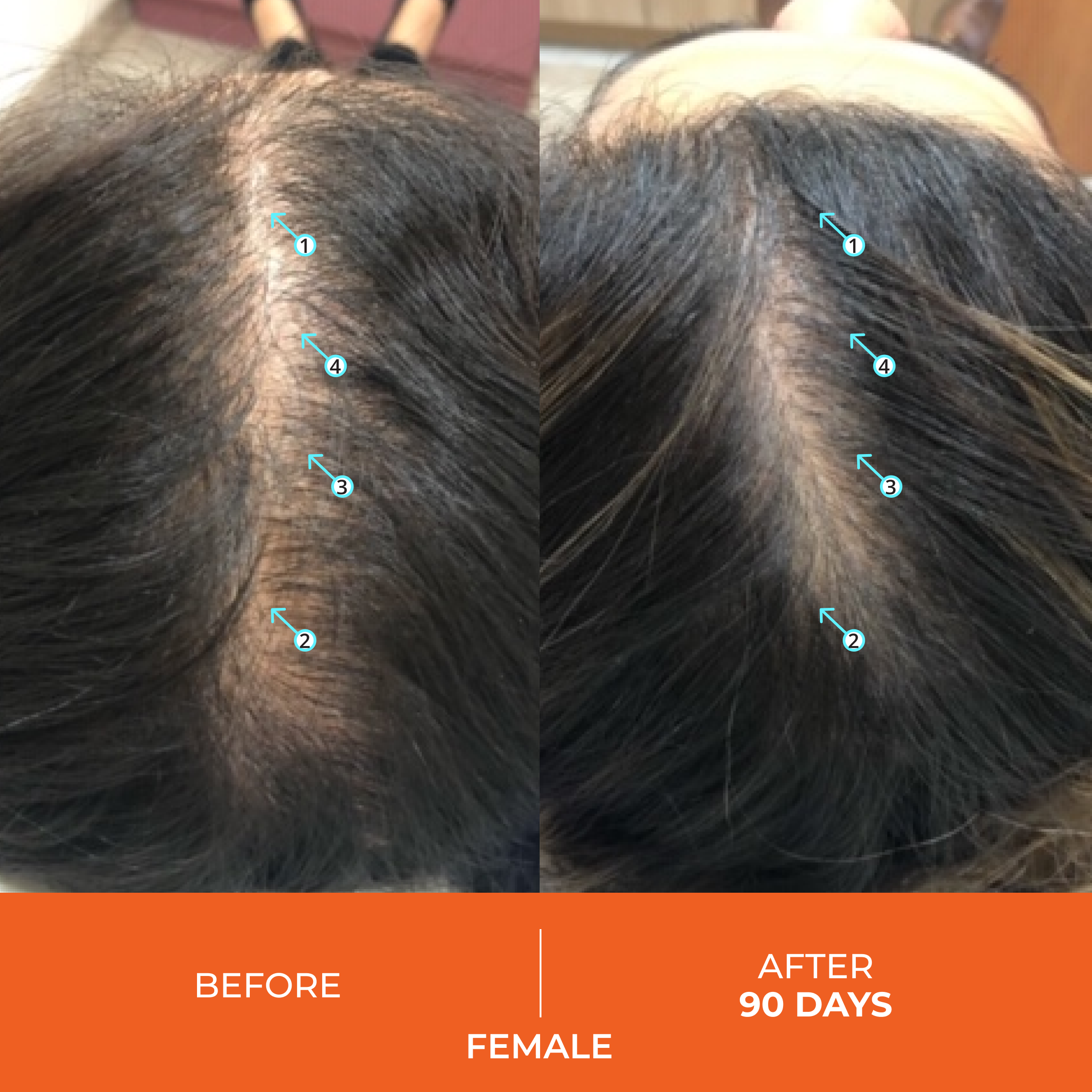 Revita Shampoo & Conditioner for Female Hair Loss: Before & After 90 Days