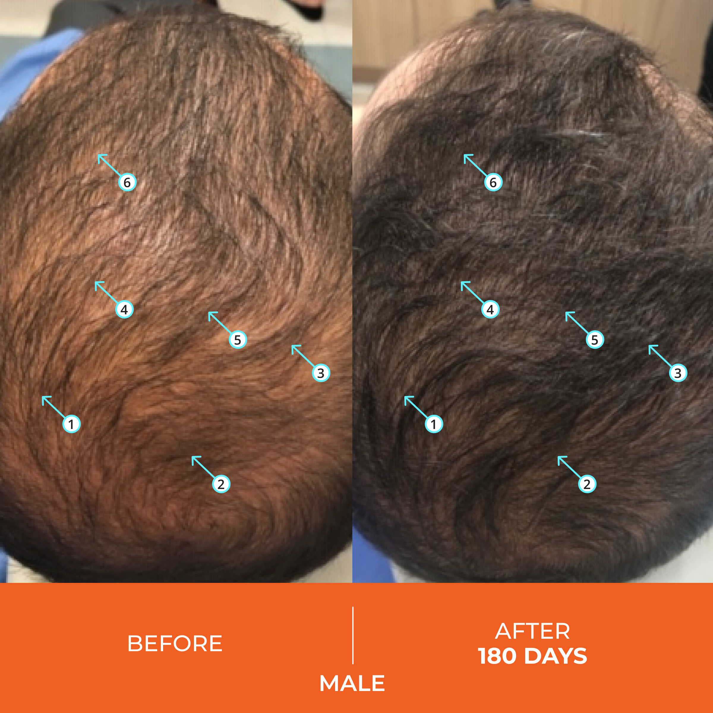 REVITA Hair Loss Treatment: Male Before & After 180 Days - See the Hair Growth Results!